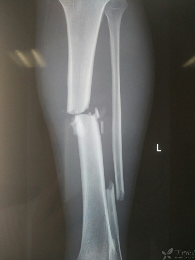 科技重塑脛腓骨骨折康復之旅，引領(lǐng)未來(lái)體驗新篇章