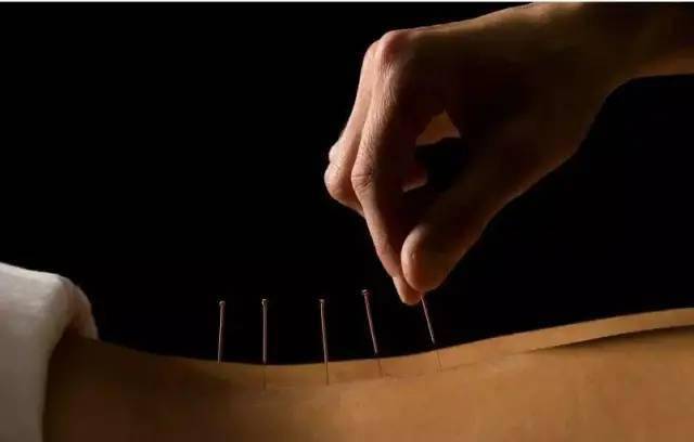 平衡針灸最新視頻，現代應用探索針灸藝術(shù)的新境界