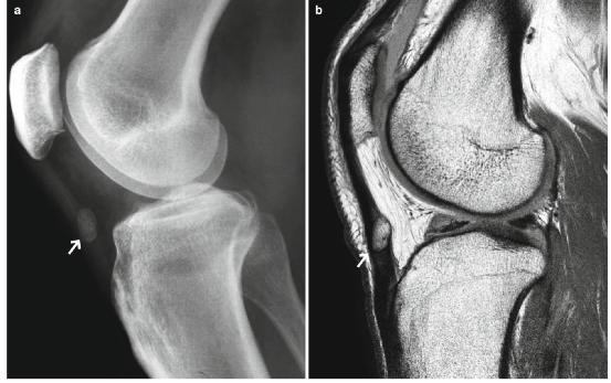 髕腱炎成為醫學(xué)焦點(diǎn)，從幕后走向舞臺中央的最新進(jìn)展