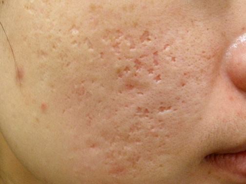 最新痘坑撫平神器，科技重塑肌膚之美，自信生活從此開(kāi)始