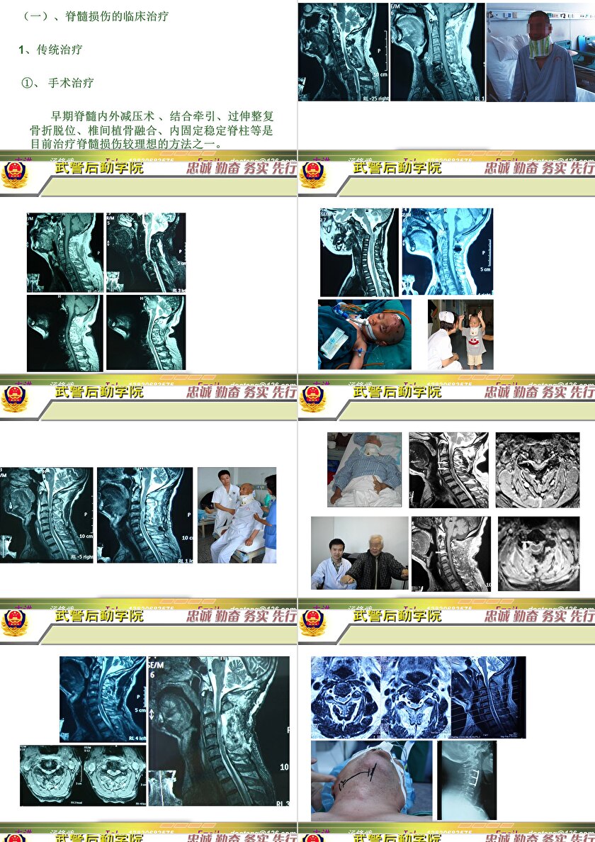 2023年脊髓損傷研究新進(jìn)展，里程碑式的突破與日常奇妙變化