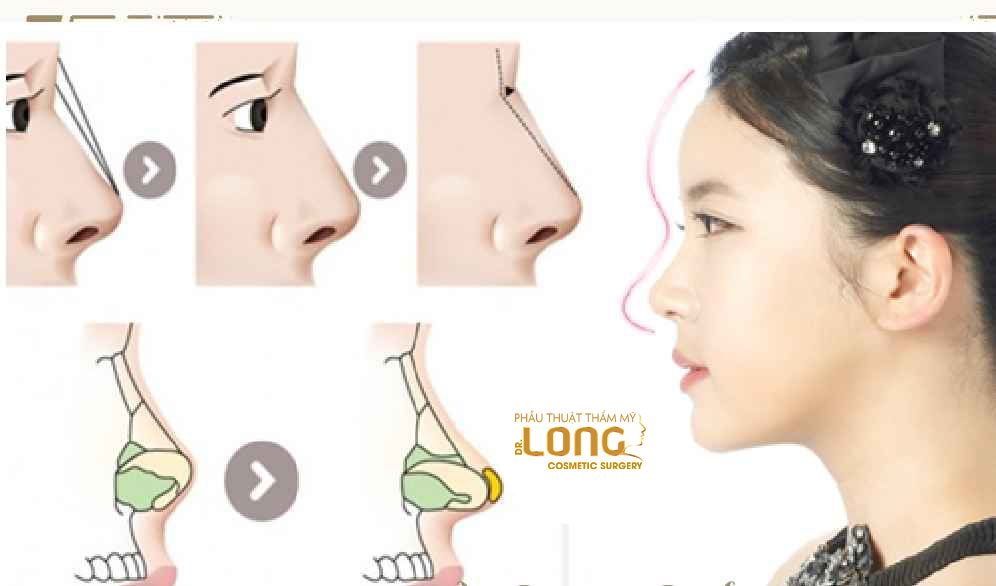 最新鼻整形技術(shù)重塑自信，煥發(fā)新生之美