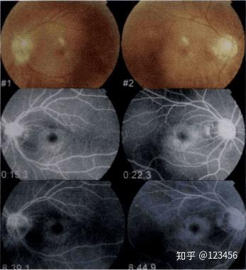 最新藥肺炎詳解，你需要知道的一切——健康小紅書(shū)